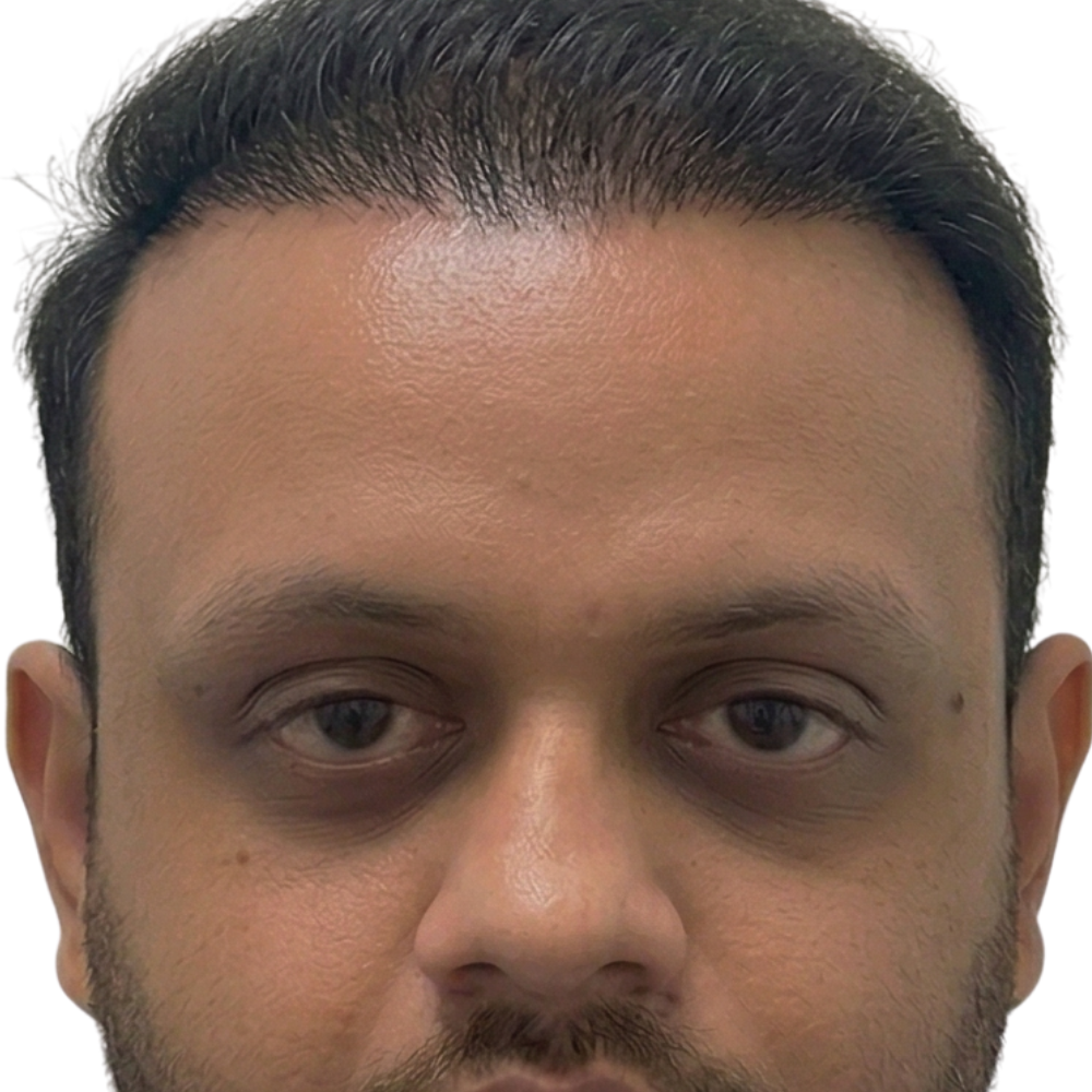 After Hair Transplant