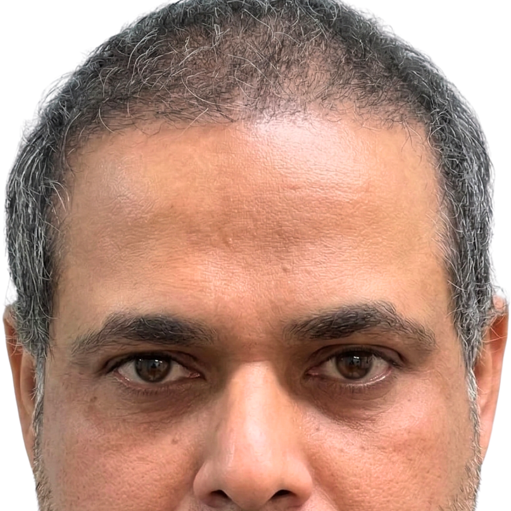 After Hair Transplant