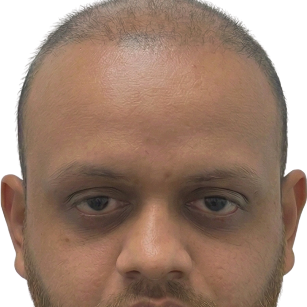 Before Hair Transplant