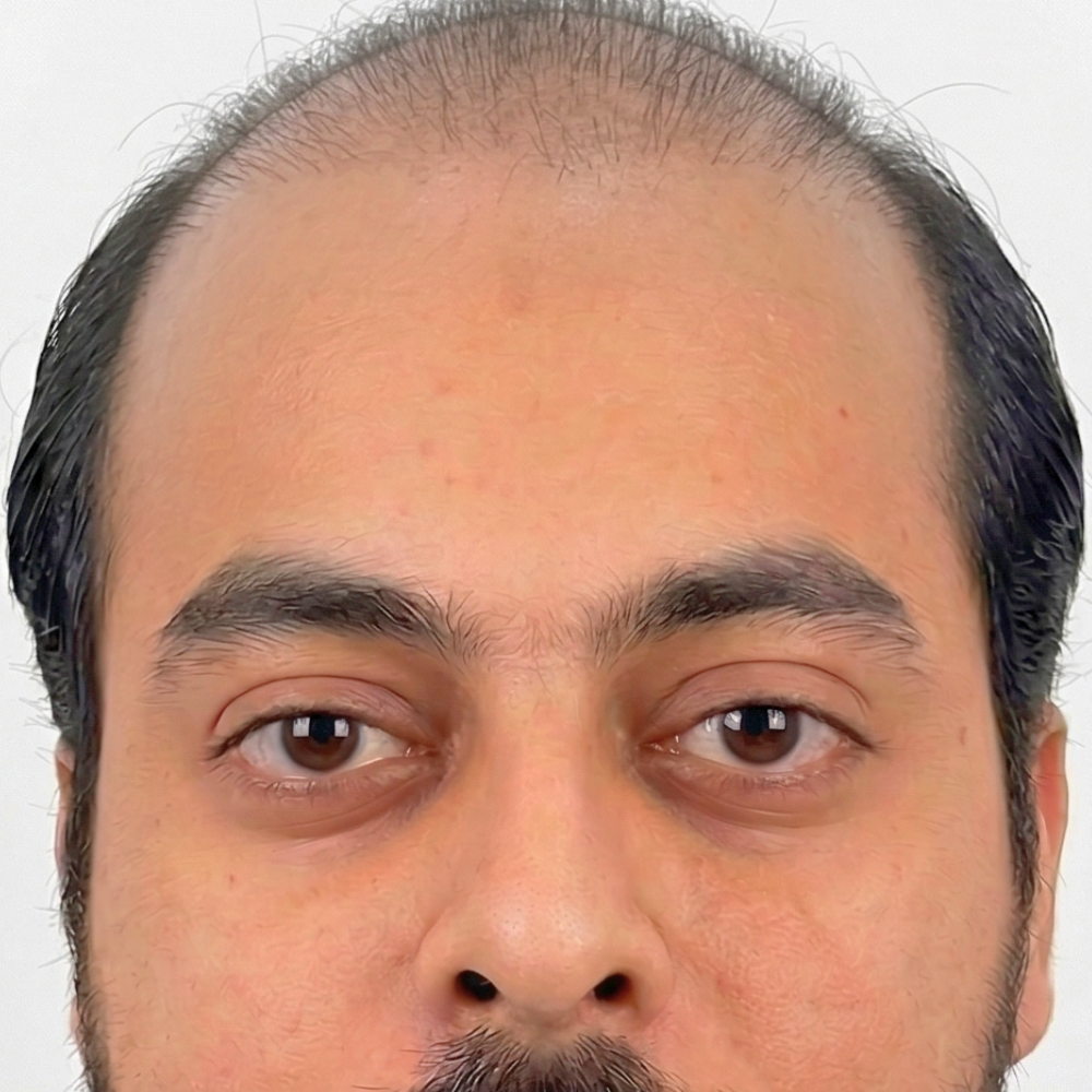 Before Hair Transplant