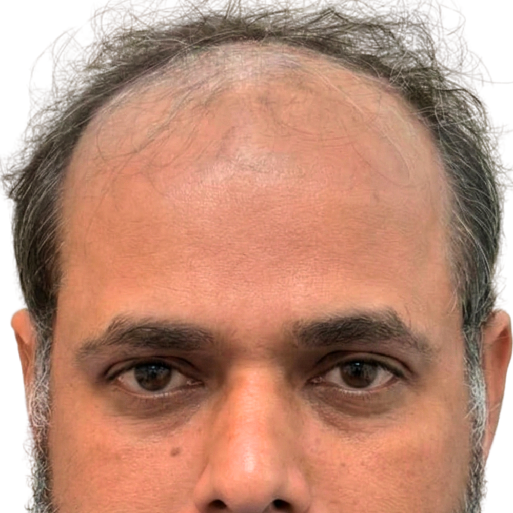 Before Hair Transplant
